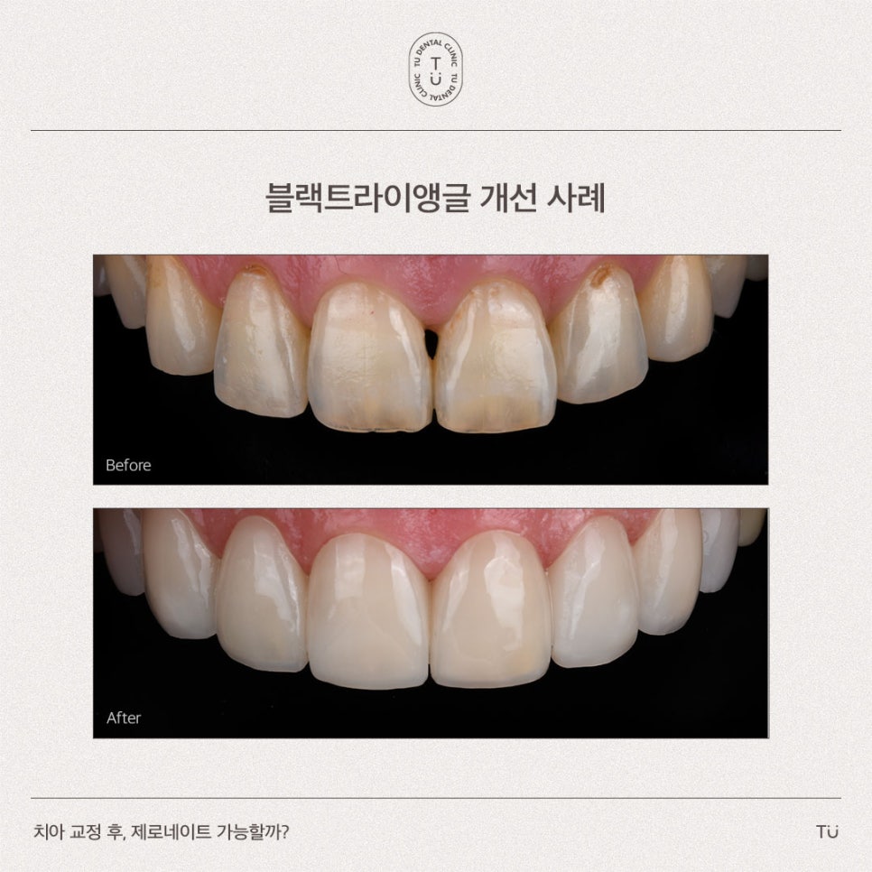 [티유치과] 치아 교정 후, 제로네이트 가능할까요?[TU치과] 관련 이미지 2