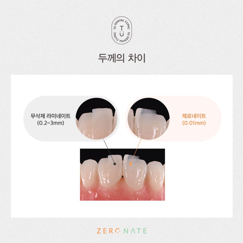 티유치과 무삭제 라미네이트와 제로네이트의 차이는?[TU치과] 관련 이미지 2