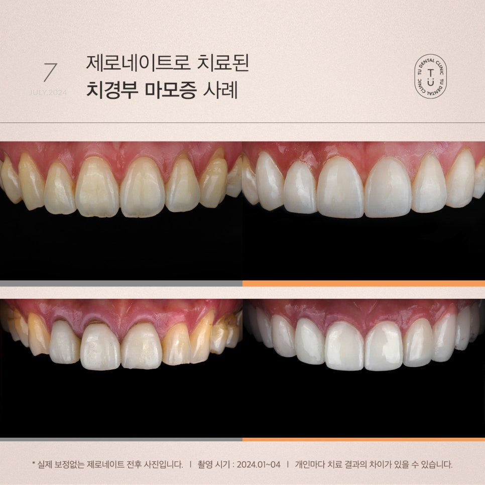 티유치과 7월 매거진, 치경부 마모증 치료법 [TU치과] 관련 이미지 7