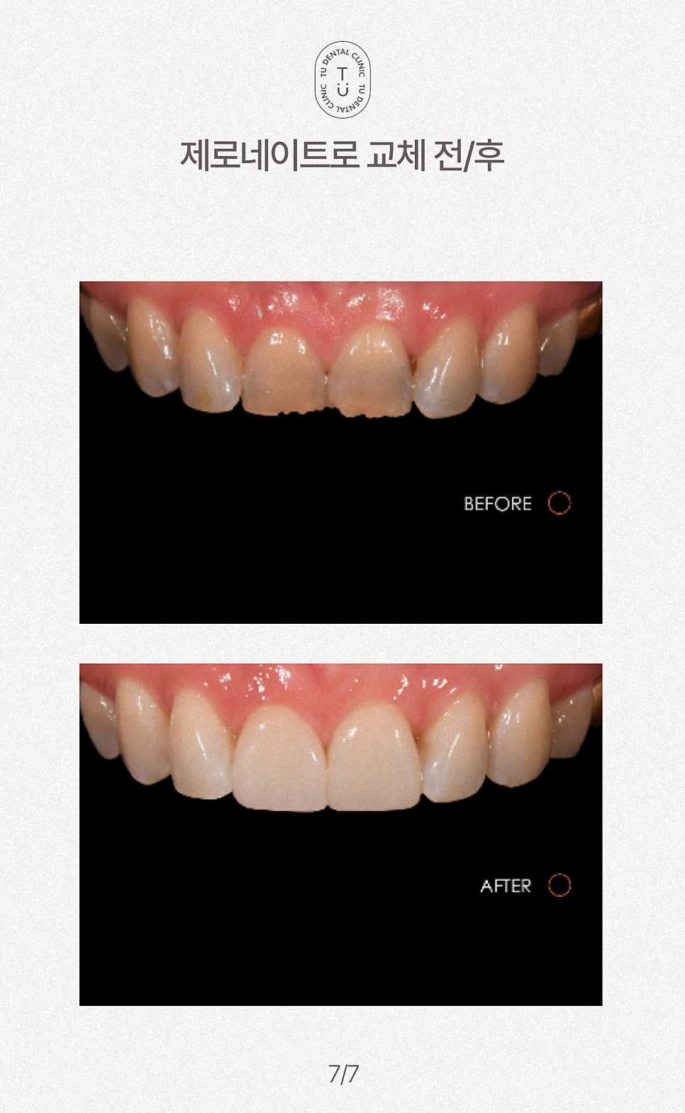 치아 반영구적으로 하얘지는 법, 티유치과[TU치과] 관련 이미지 8