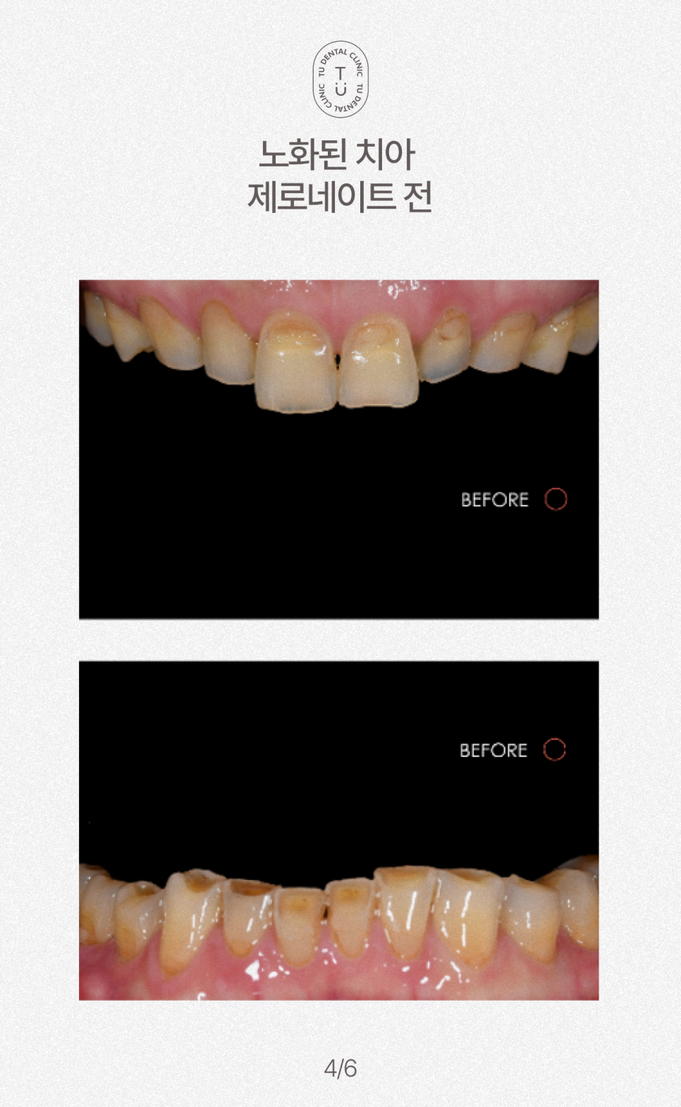 노화된 치아에 제로네이트 하세요, 티유치과[TU치과] 관련 이미지 5