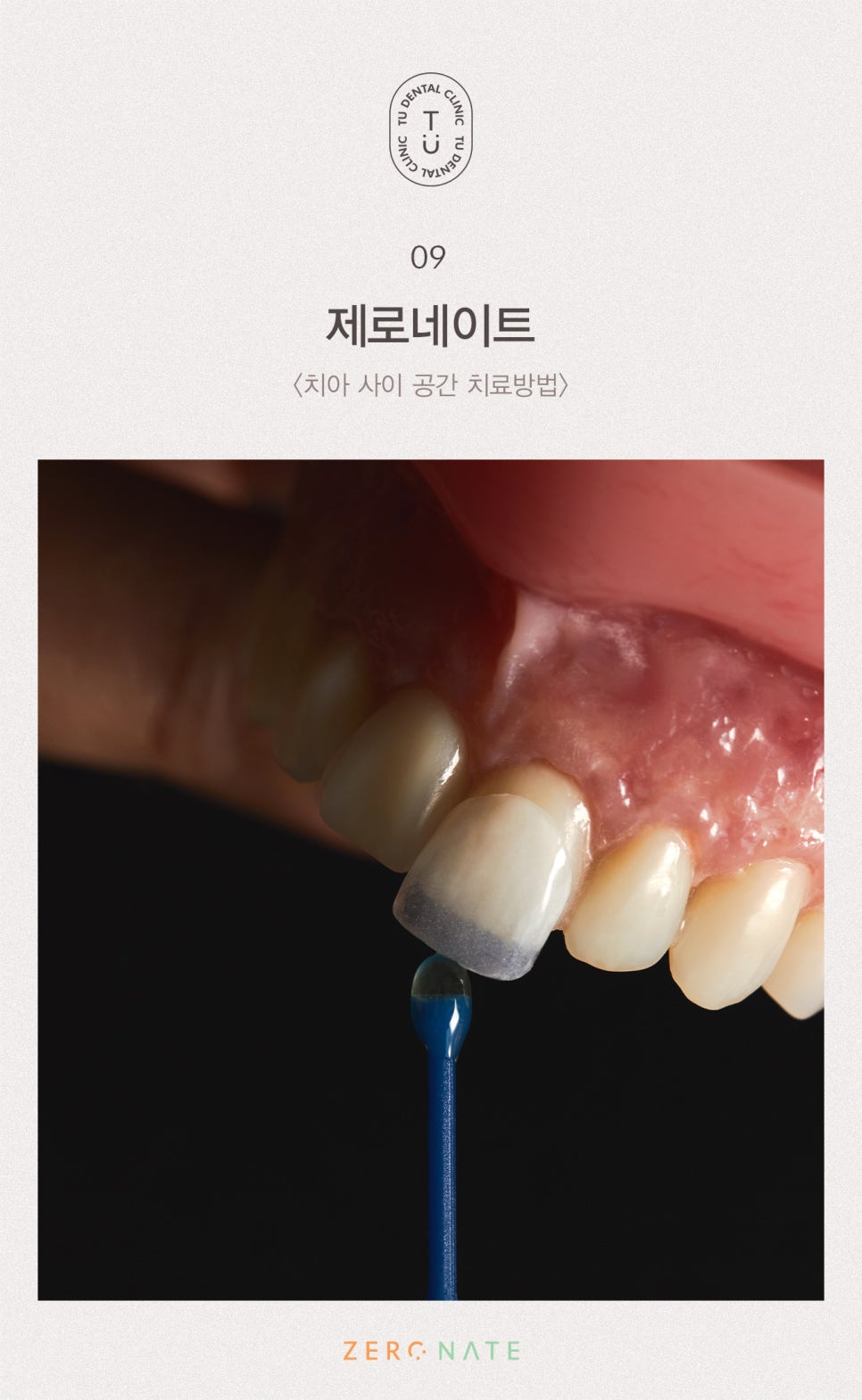 치아 사이 공간 치료방법, 티유치과[TU치과] 관련 이미지 10