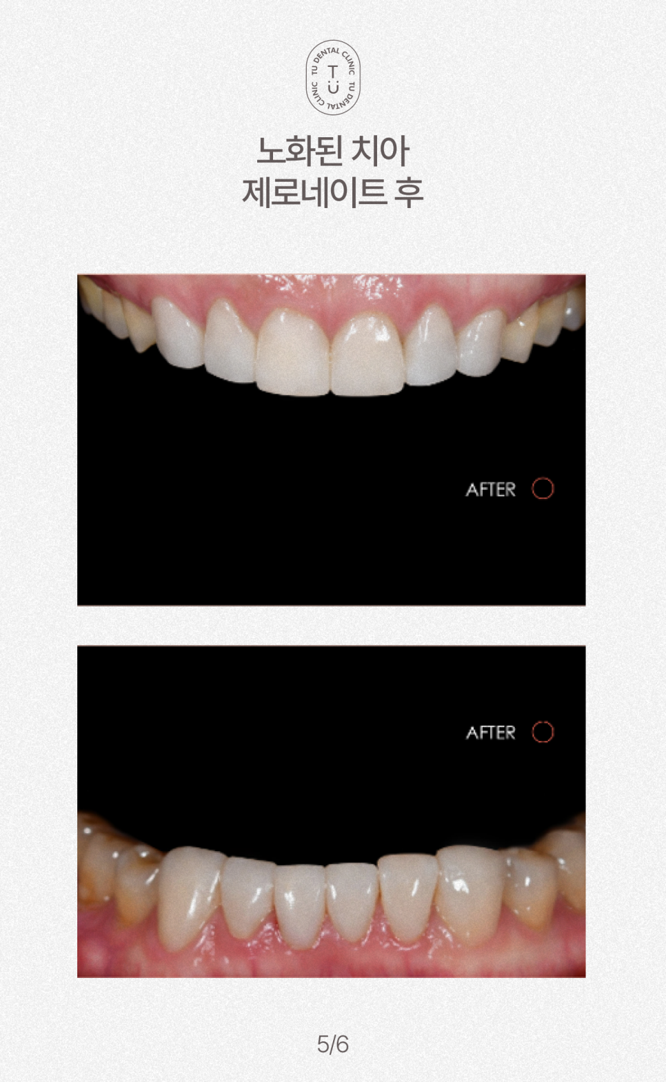 노화된 치아에 제로네이트 하세요, 티유치과[TU치과] 관련 이미지 6