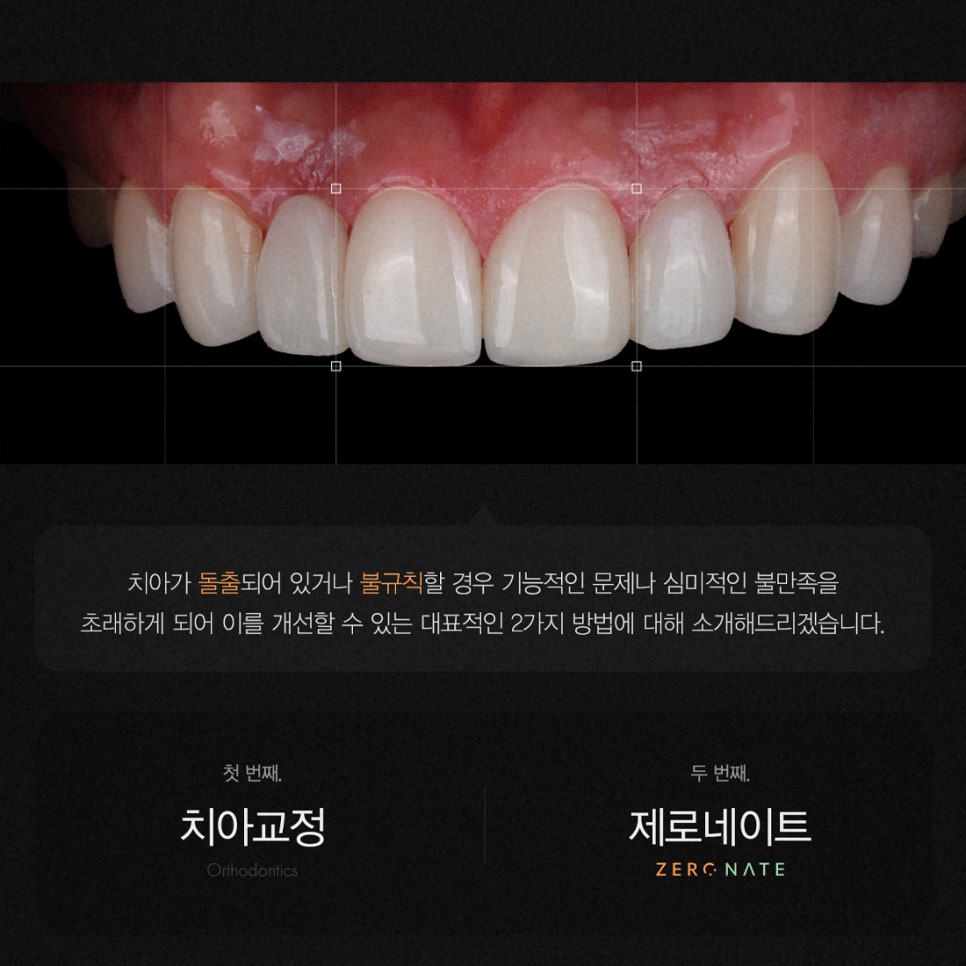 티유치과 3월 매거진 돌출, 불규칙한 치아의 치료법 [TU치과] 관련 이미지 3