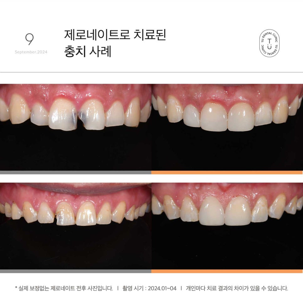 티유치과 9월 매거진, 앞니 충치의 개선, 제로네이트[TU치과] 관련 이미지 7