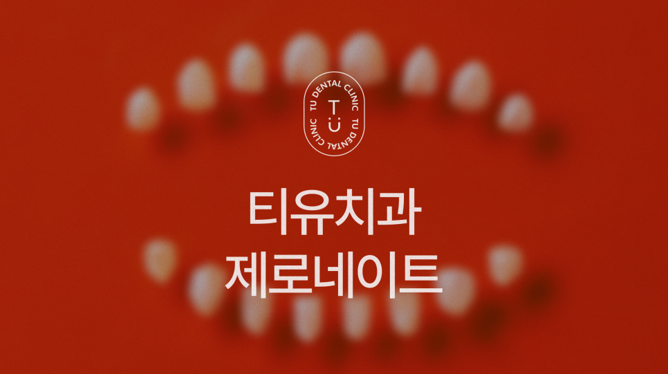 기존 자연치아를 보존하는 라미네이트 방법은? 관련 이미지 1