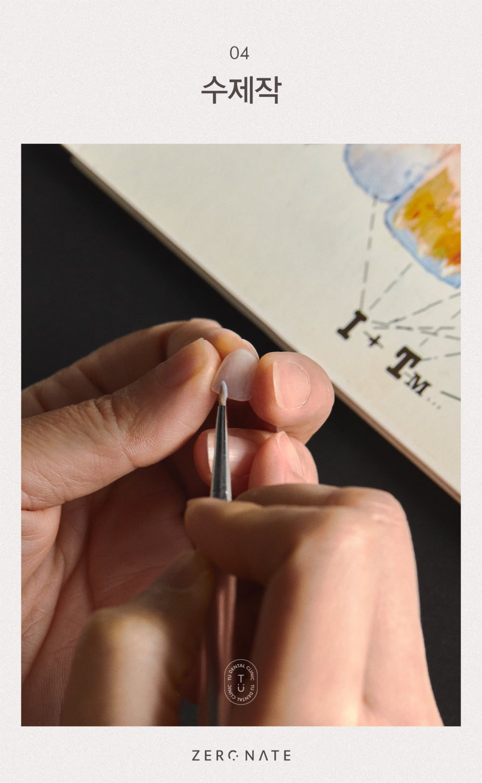 티유치과 제로네이트가 무삭제로 가능한 이유 알려드립니다 [TU치과] 관련 이미지 5