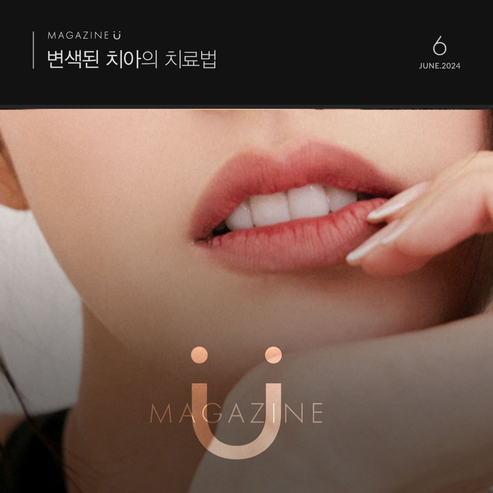 티유치과 6월 매거진, 변색된 치아의 치료법 [TU치과] 관련 이미지 1