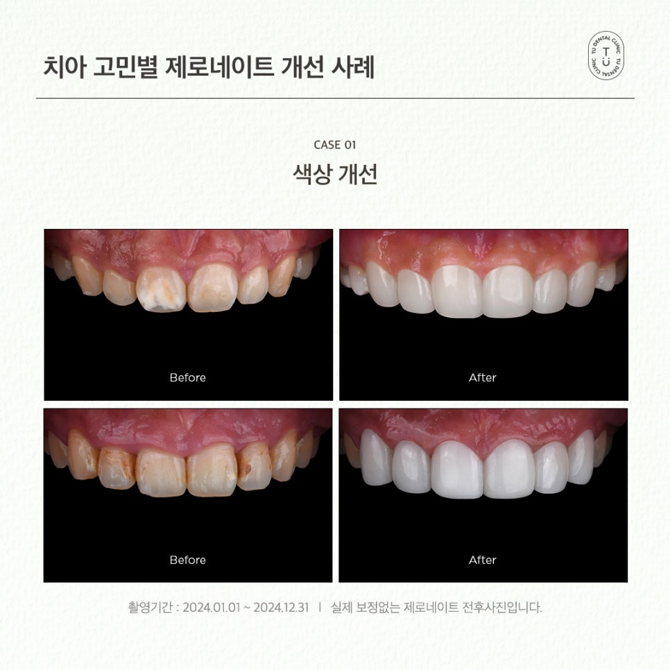 치아 고민별 제로네이트 개선 사례 (유형별 라미네이트 전후) 관련 이미지 4