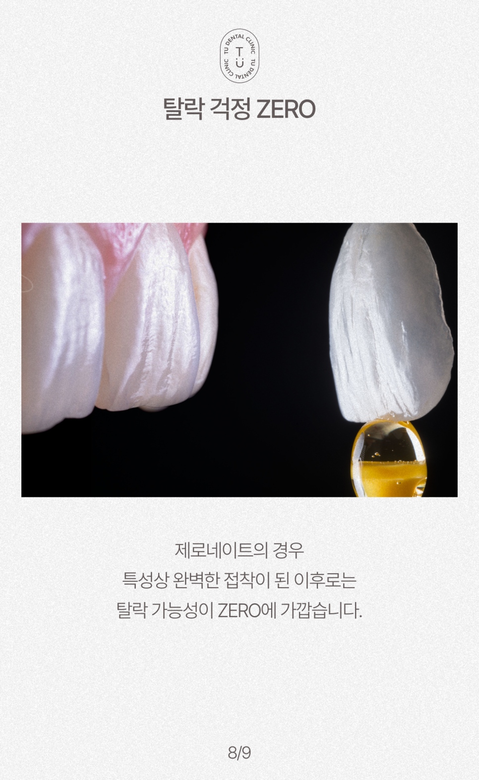 라미네이트 탈락 대처법(feat. 제로네이트는 탈락이 거의 없음) 티유치과[TU치과] 관련 이미지 9