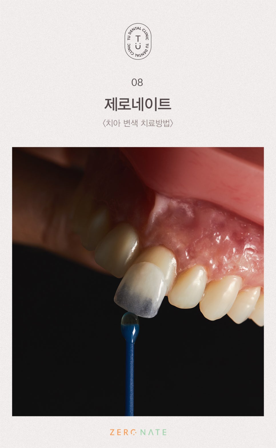 변색된 치아 치료방법, 티유치과 제로네이트 [TU치과] 관련 이미지 9