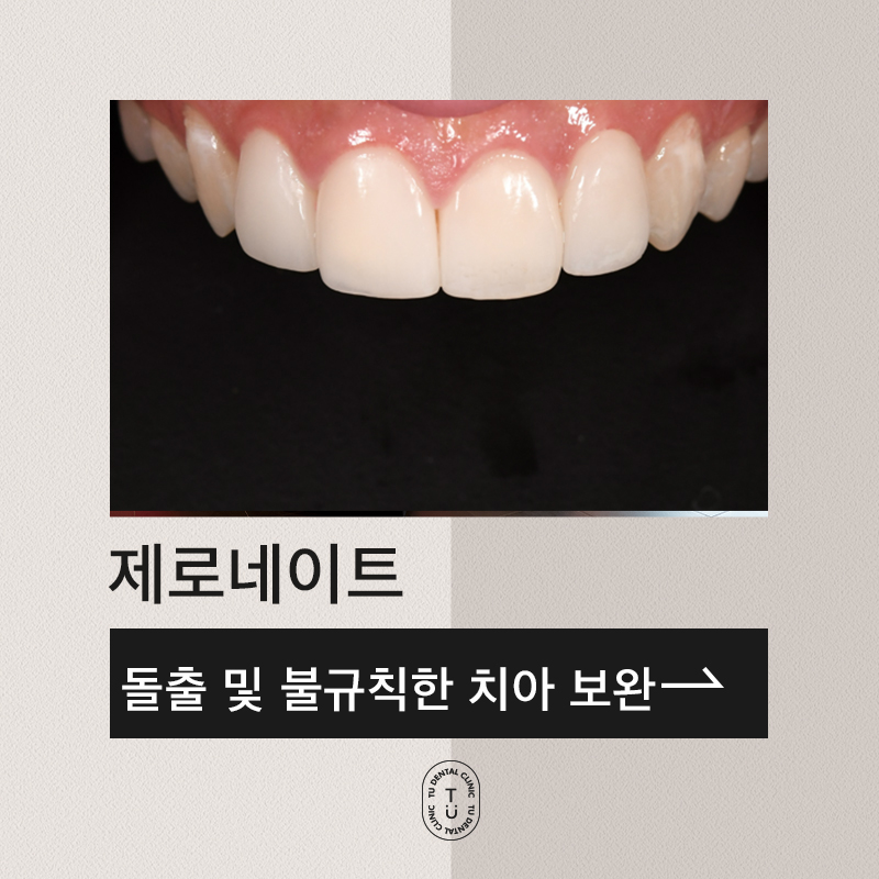 돌출 및 불규칙한 치아의 모양 보완 : 제로네이트 관련 이미지 1