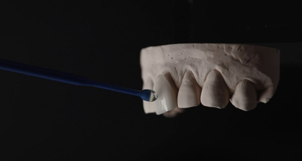 제로네이트[무삭제 라미네이트] / 티유치과, 강남역 치과 관련 이미지 1