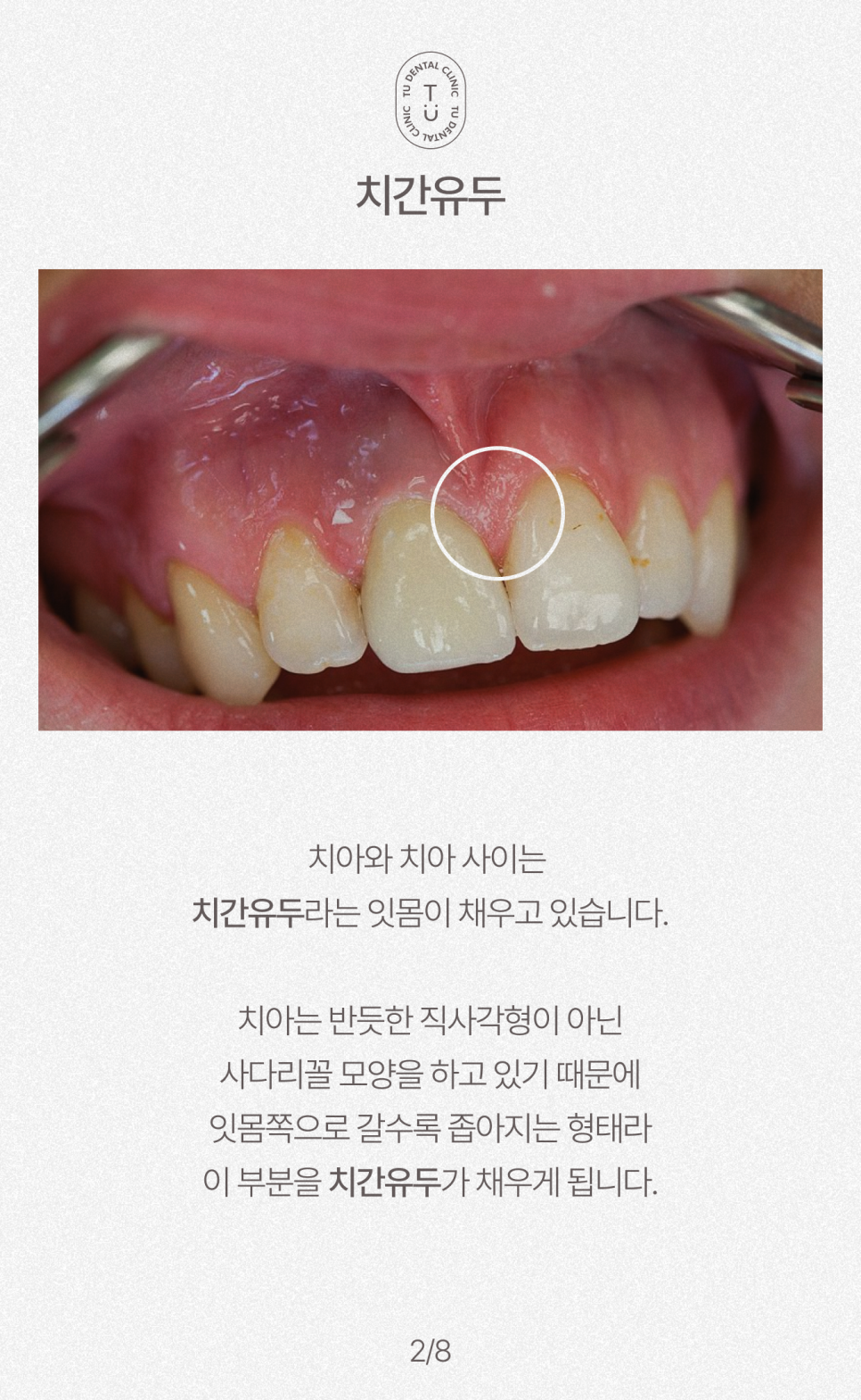 치아 사이 구멍, 블랙트라이앵글 제로네이트로 해결하세요 관련 이미지 3