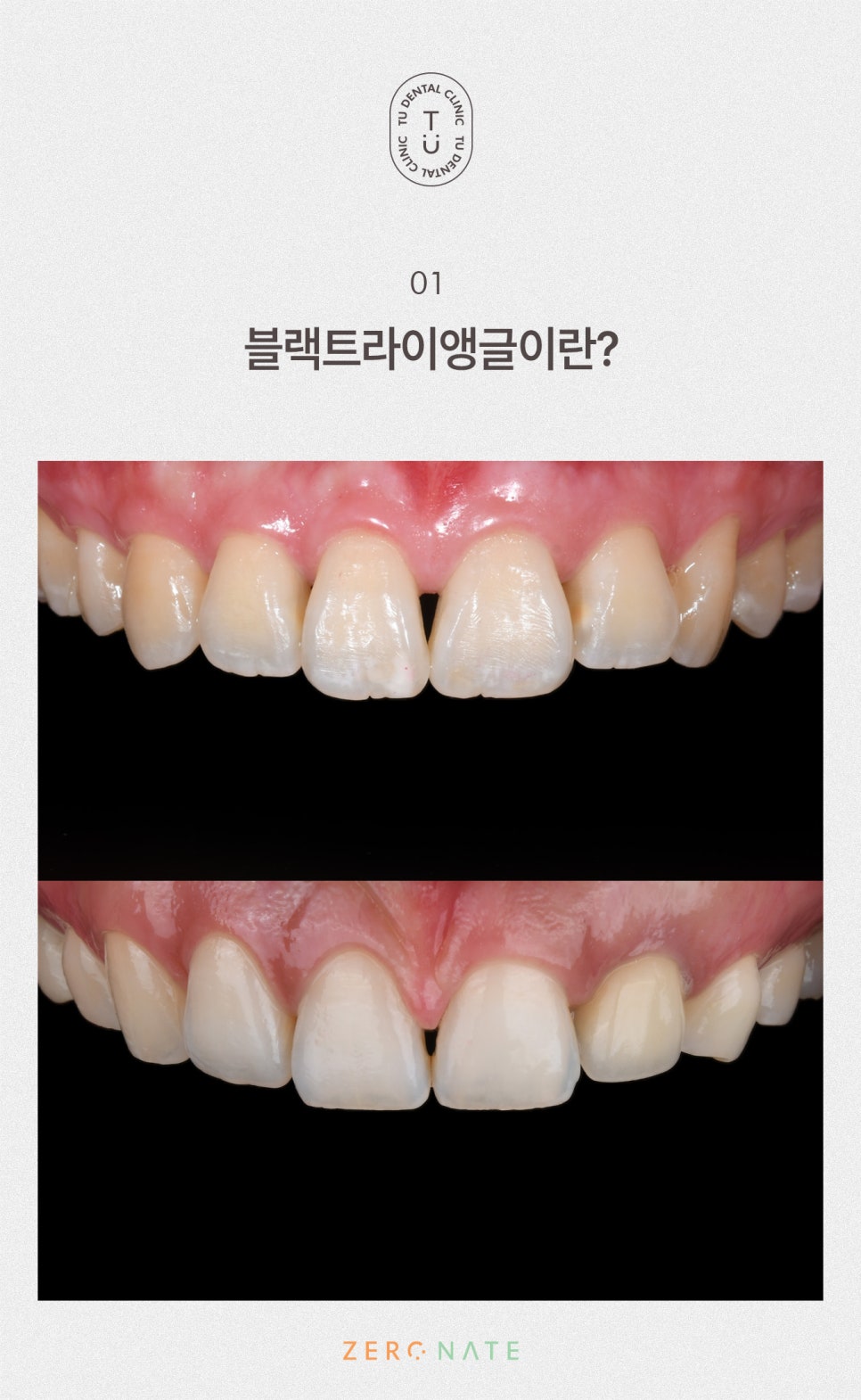 티유치과 블랙트라이앵글 제로네이트 [TU치과] 관련 이미지 2