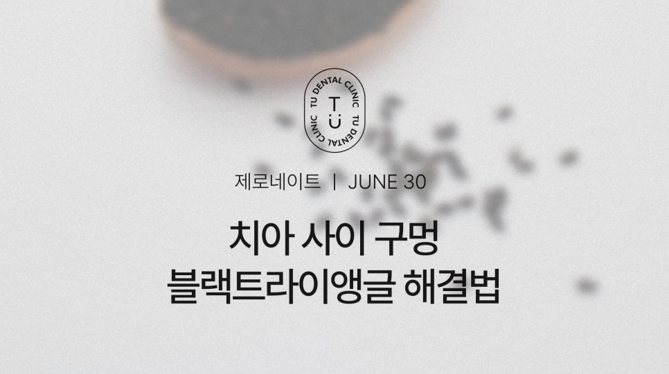 치아 사이 구멍, 블랙트라이앵글 제로네이트로 해결하세요 관련 이미지 1