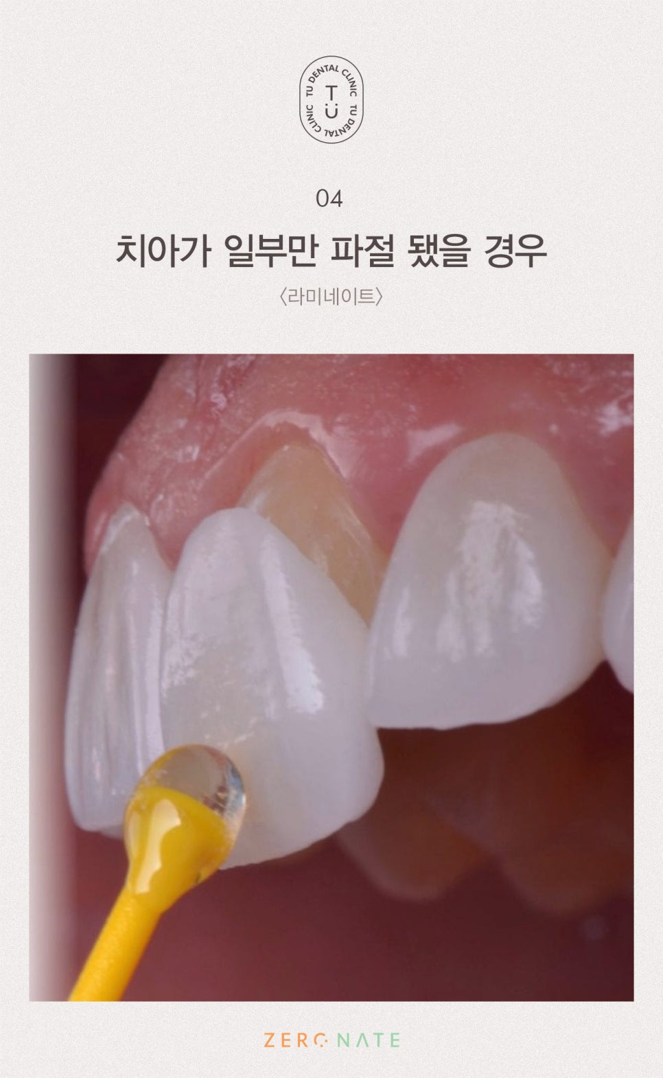 파절된 치아 치료방법, 티유치과[TU치과] 관련 이미지 5