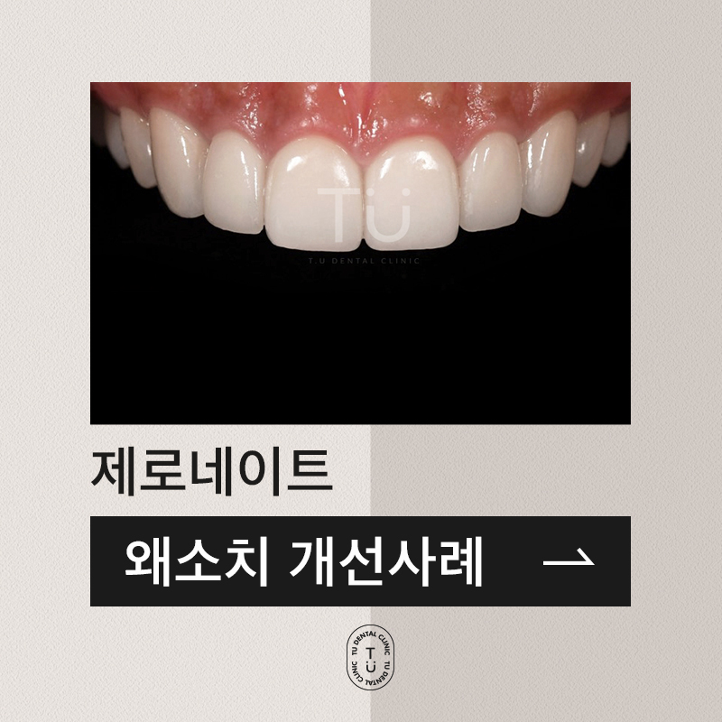 앞니 왜소치 개선 사례 : 제로네이트 관련 이미지 1