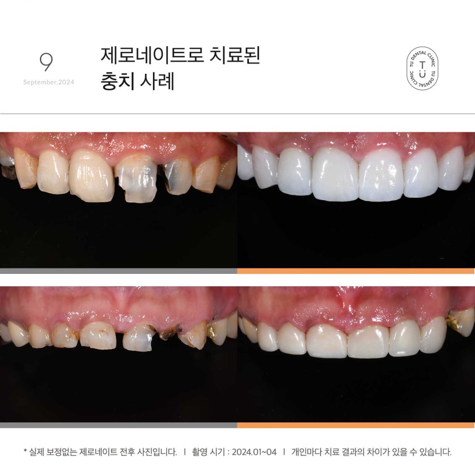 티유치과 9월 매거진, 앞니 충치의 개선, 제로네이트[TU치과] 관련 이미지 6