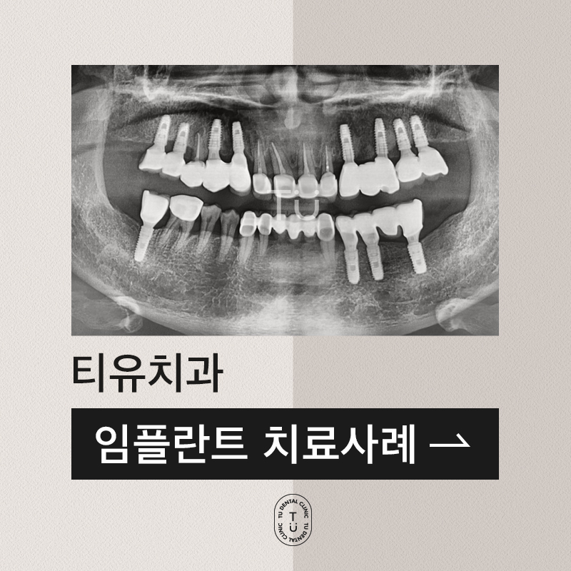 TU 임플란트 치료사례 : 상악 브릿지 관련 이미지 1