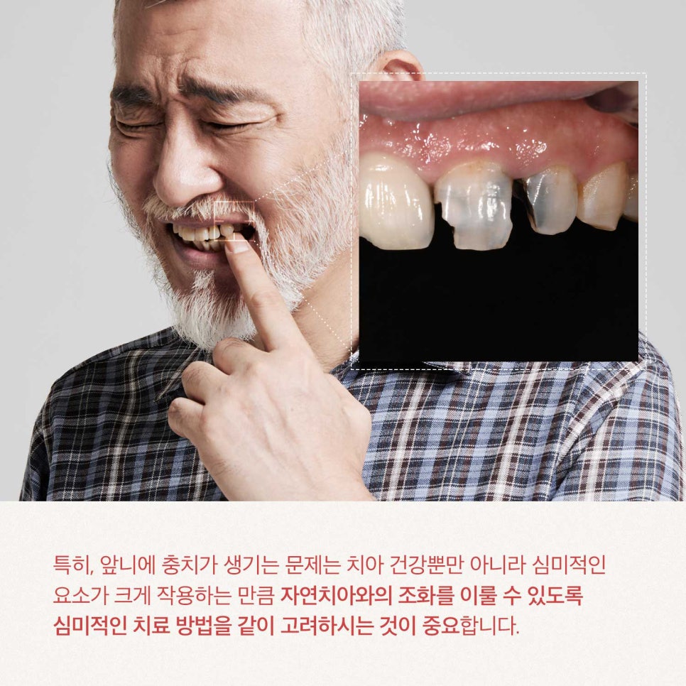 티유치과 9월 매거진, 앞니 충치의 개선, 제로네이트[TU치과] 관련 이미지 3