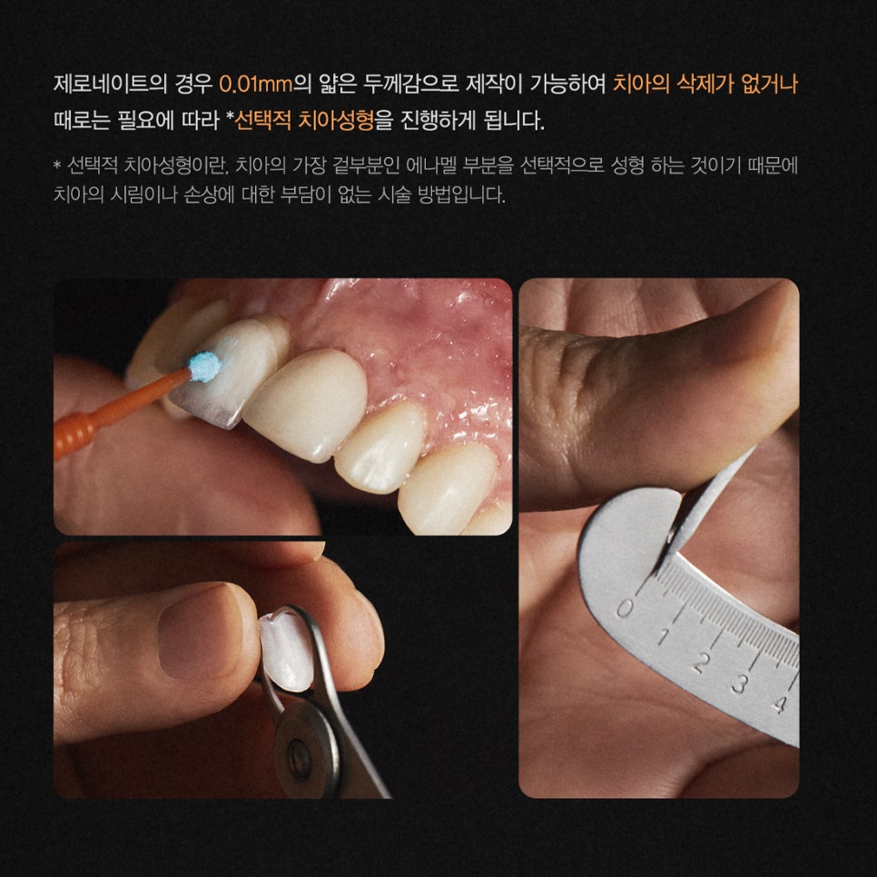 티유치과 3월 매거진 돌출, 불규칙한 치아의 치료법 [TU치과] 관련 이미지 7