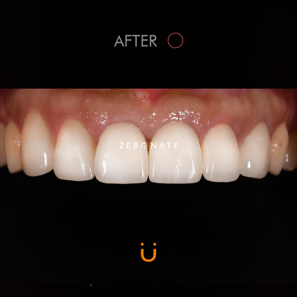 TU치과 제로네이트 사례 : 치아모양 개선 관련 이미지 3