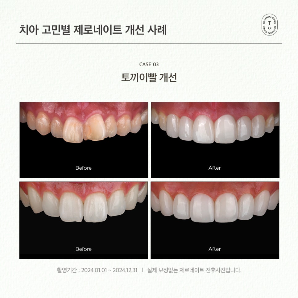 치아 고민별 제로네이트 개선 사례 (유형별 라미네이트 전후) 관련 이미지 6