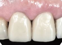 [TU치과/티유치과]임플란트 관련 이미지 3