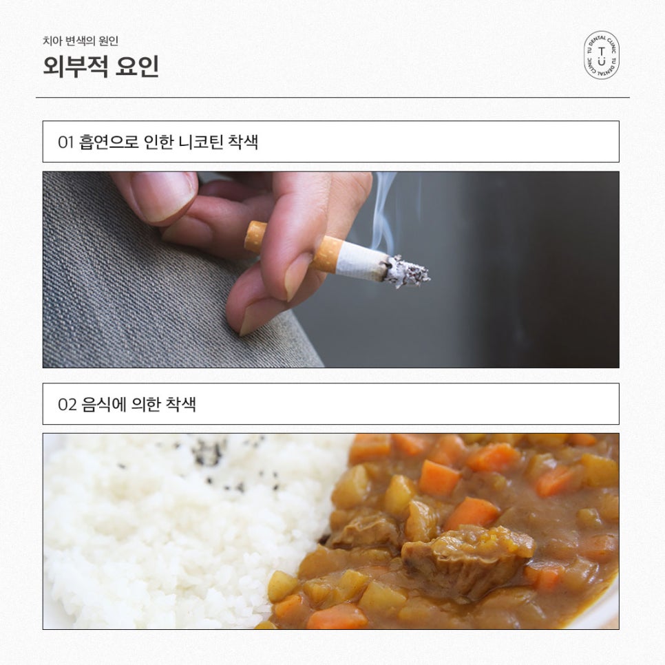 [티유치과] 치아미백으로 해결되지 않는 변색 치아의 치료법, 제로네이트 관련 이미지 2