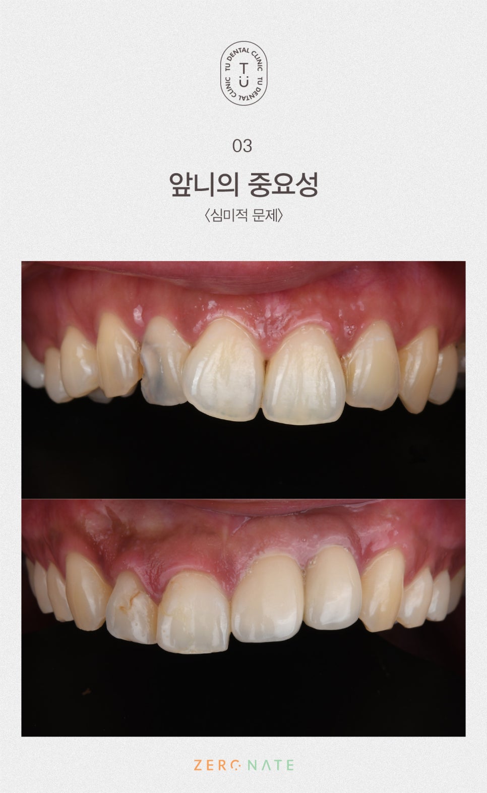 티유치과 돌출,불규칙한 치아 제로네이트[TU치과] 관련 이미지 4