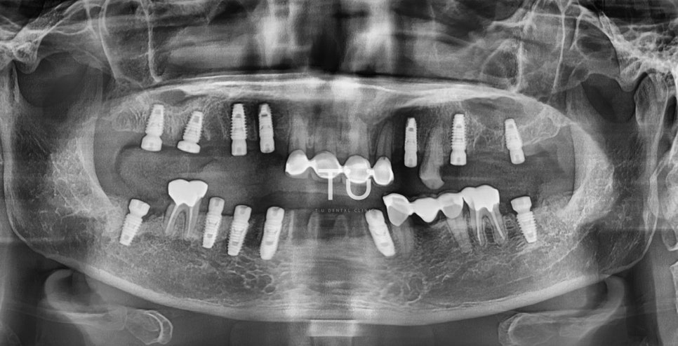TU 임플란트 치료사례 : 구치부, 브릿지 관련 이미지 3