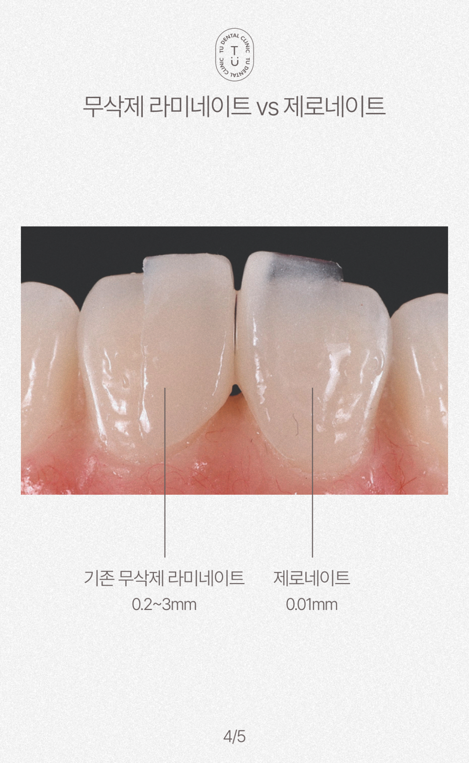완전 무삭제 라미네이트, 제로네이트는 TU치과 [티유치과] 관련 이미지 5