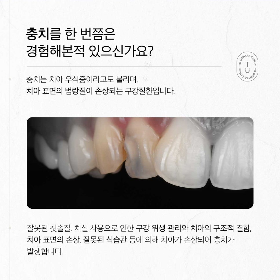 티유치과 9월 매거진, 앞니 충치의 개선, 제로네이트[TU치과] 관련 이미지 2