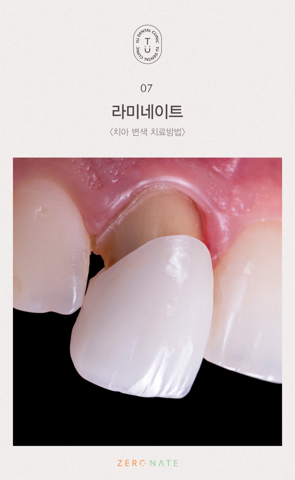 변색된 치아 치료방법, 티유치과 제로네이트 [TU치과] 관련 이미지 8