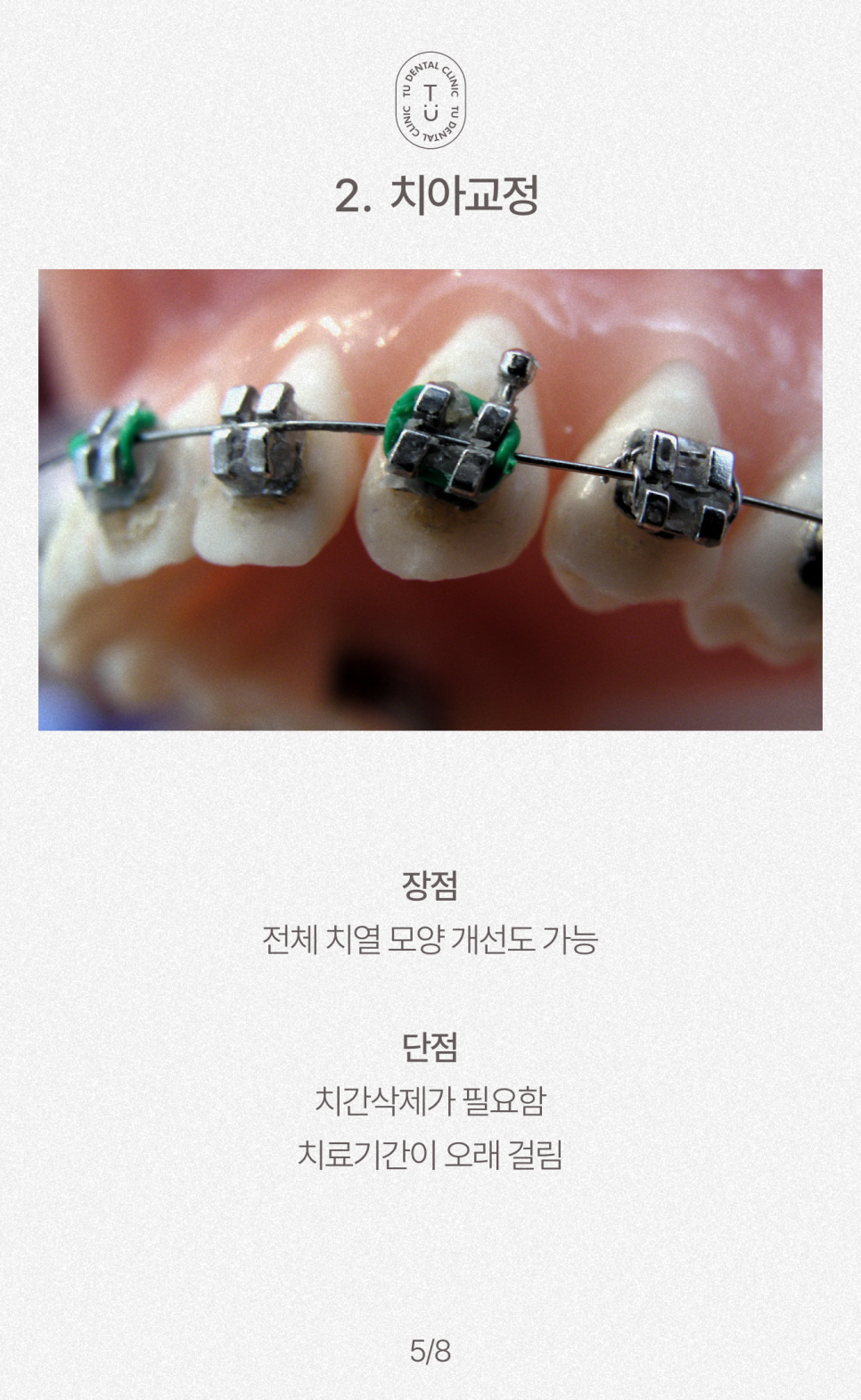 치아 사이 구멍, 블랙트라이앵글 제로네이트로 해결하세요 관련 이미지 6