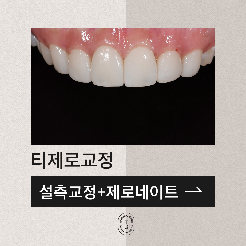 티안나게 예뻐지는 비밀교정, 티제로교정 사례 관련 이미지 1