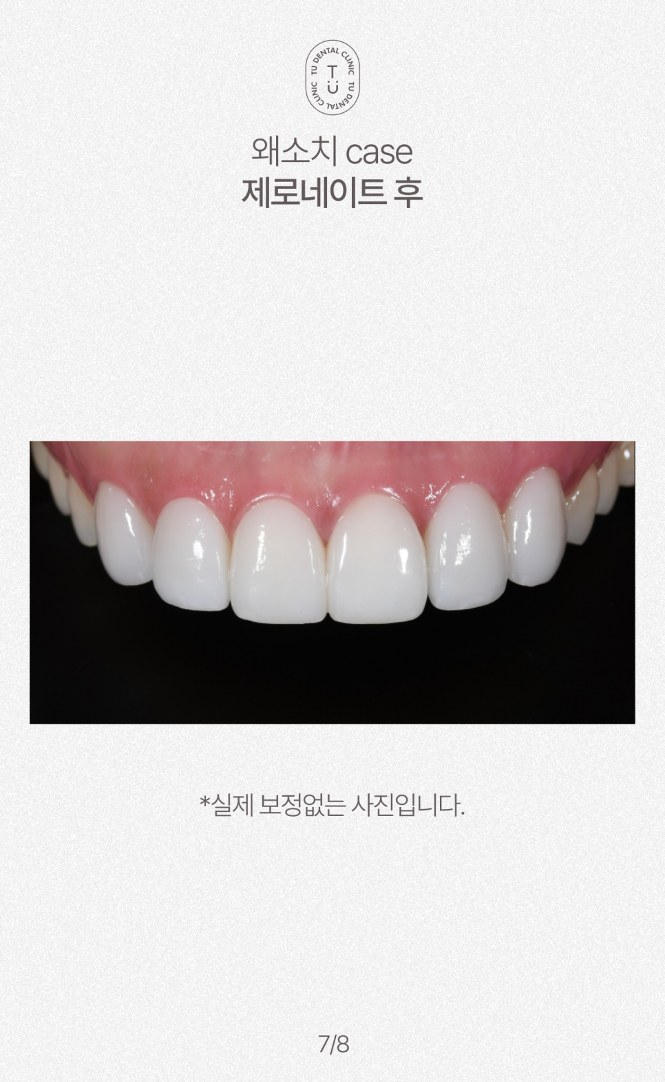 왜소치 치료방법, 작은치아 라미네이트, 제로네이트 알려드립니다! 티유치과[TU치과] 관련 이미지 8