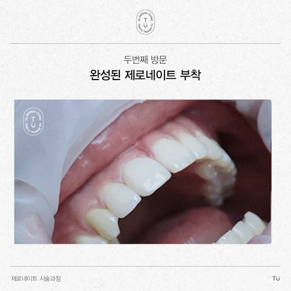 티유치과 제로네이트 시술과정 [TU치과] 관련 이미지 4