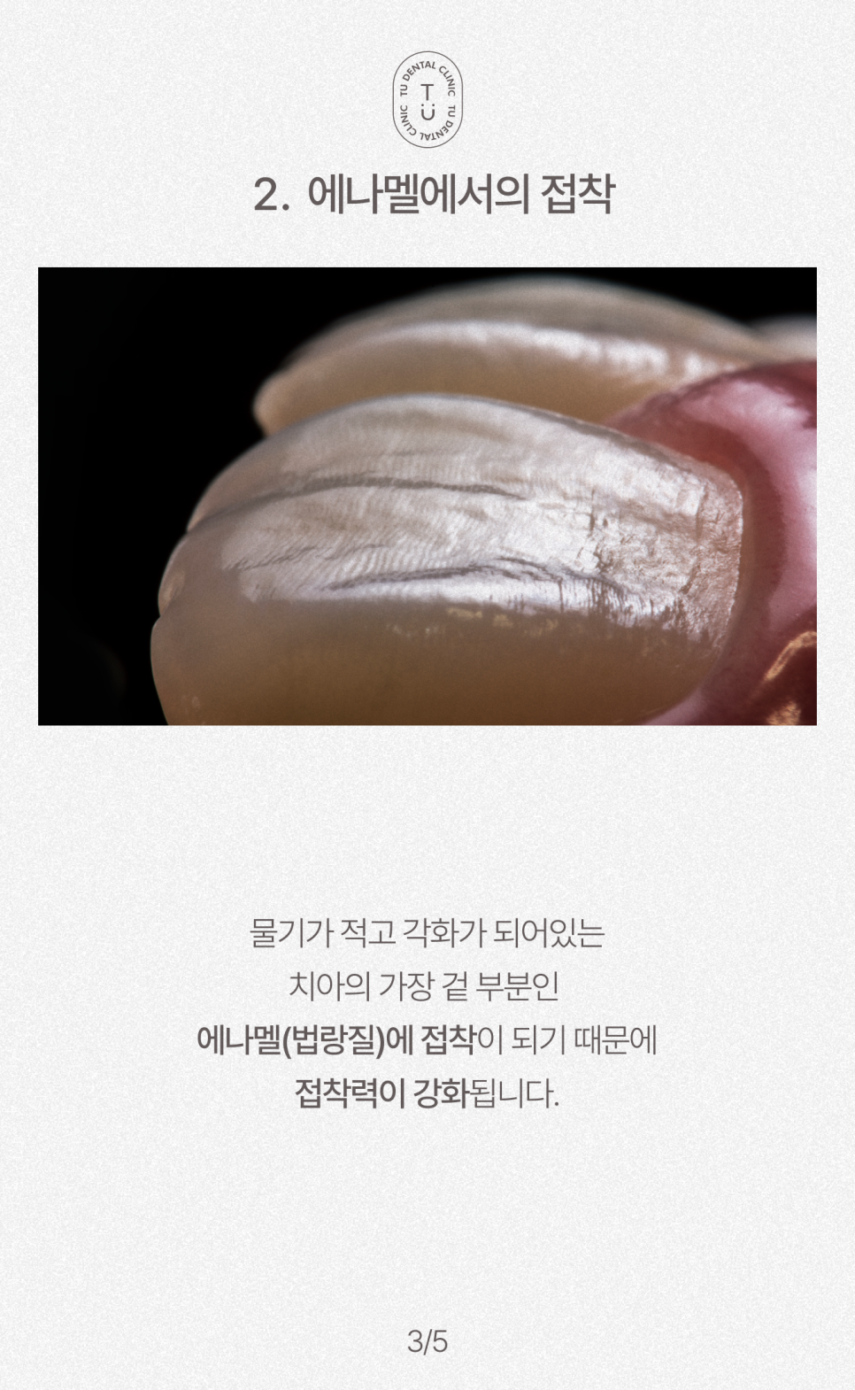 무삭제 라미네이트, 제로네이트 깨질까봐 걱정이신가요? [TU치과] 관련 이미지 4