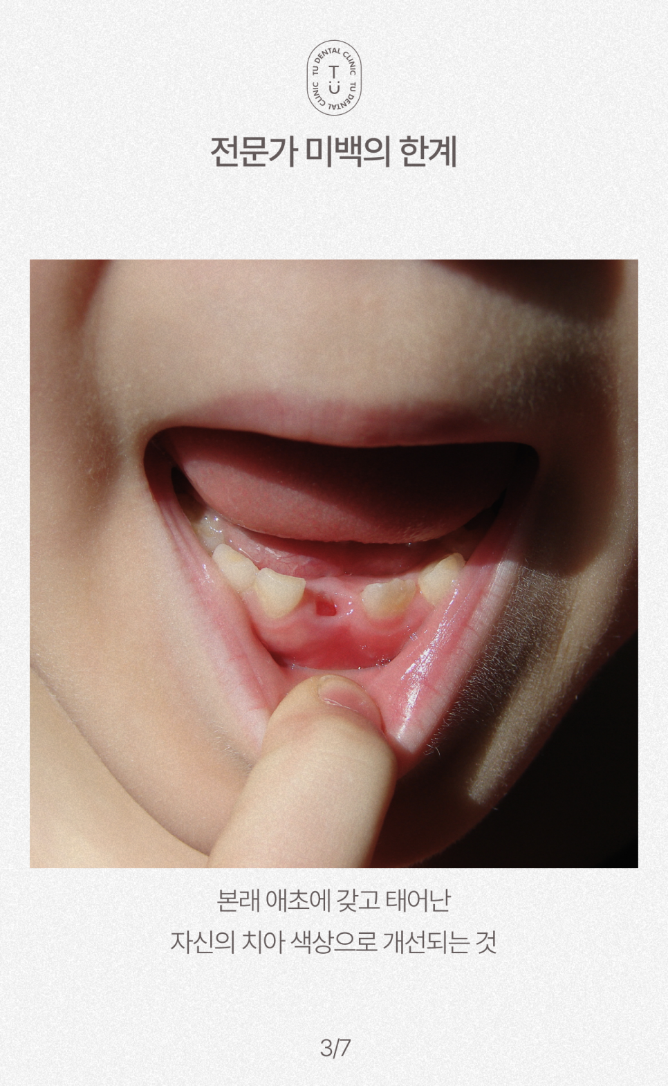 치아 반영구적으로 하얘지는 법, 티유치과[TU치과] 관련 이미지 4