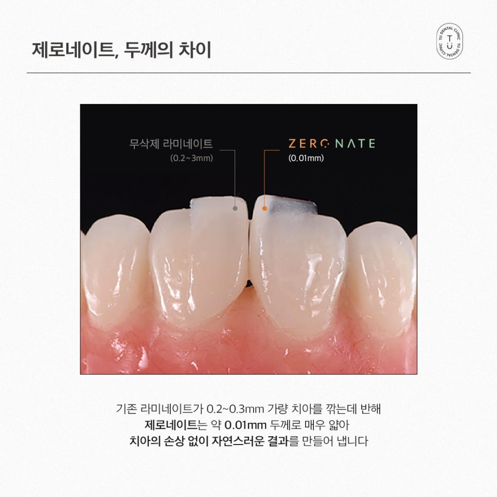 내 치아도 제로네이트 될까? (제로네이트 후기) 관련 이미지 4