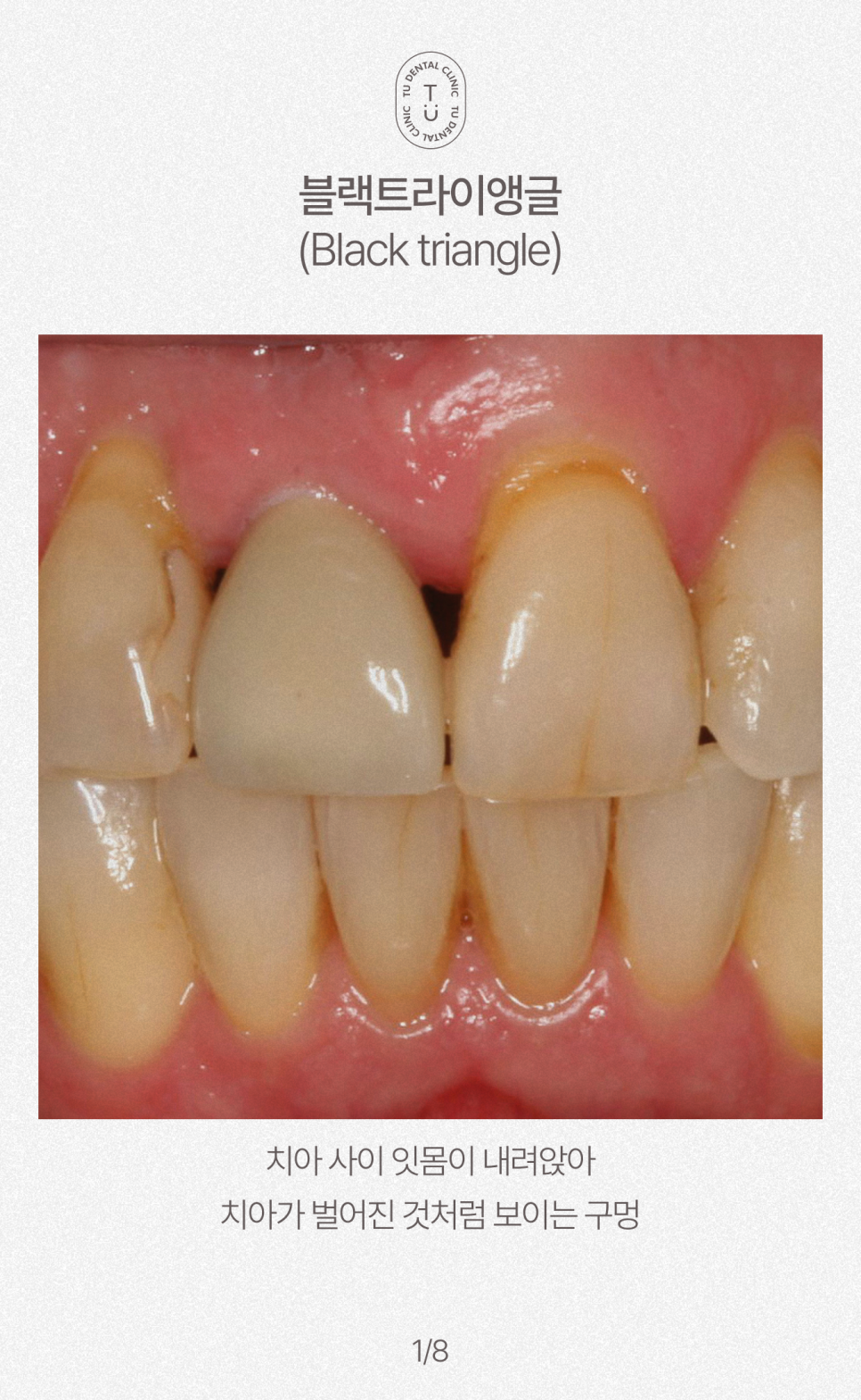 치아 사이 구멍, 블랙트라이앵글 제로네이트로 해결하세요 관련 이미지 2