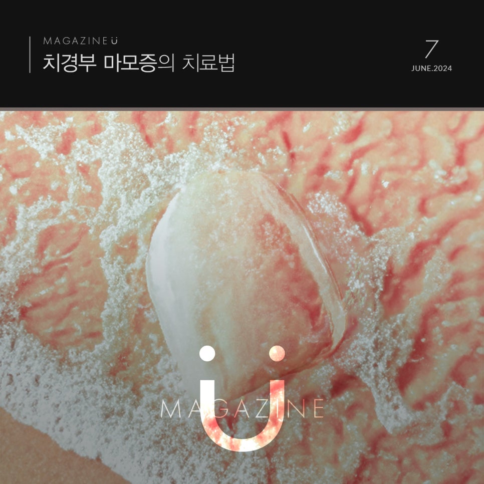 티유치과 7월 매거진, 치경부 마모증 치료법 [TU치과] 관련 이미지 1