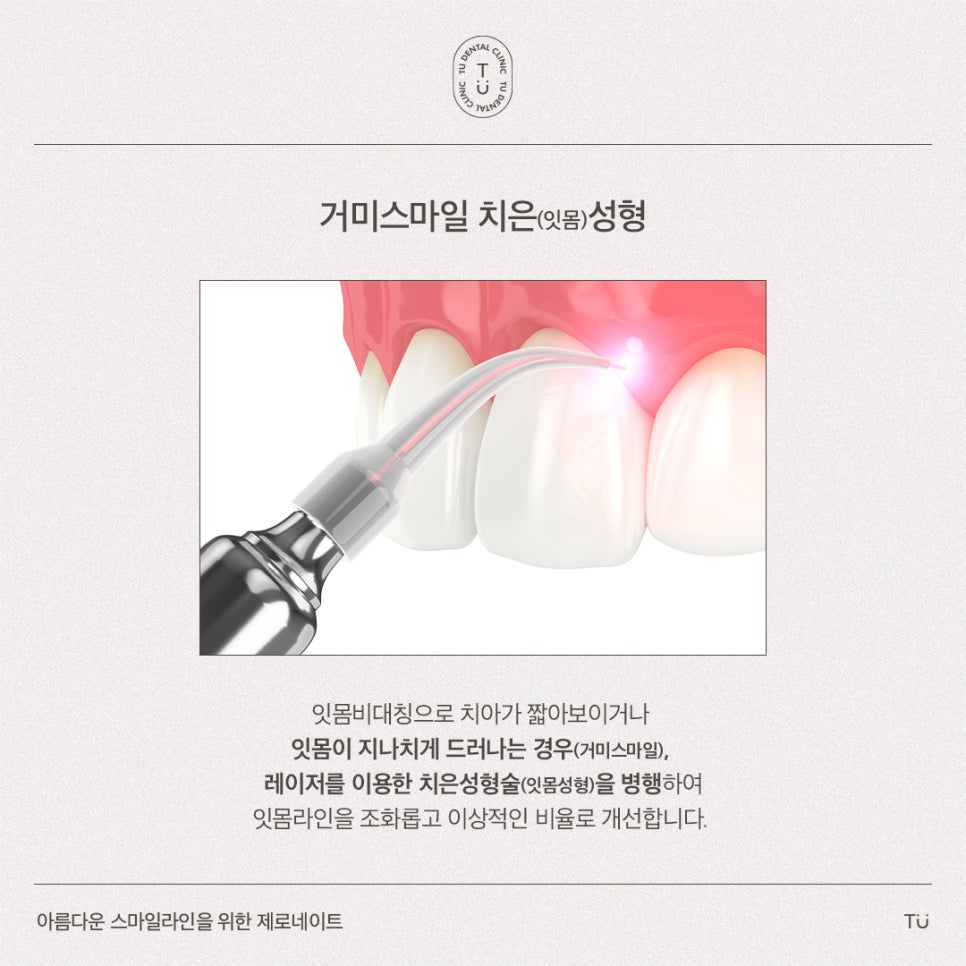 [티유치과] 아름다운 스마일라인을 위한 제로네이트 관련 이미지 5