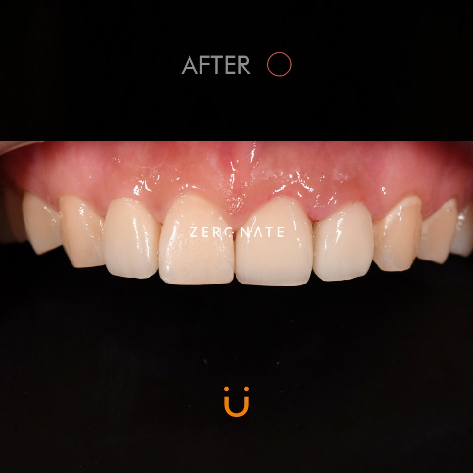 TU 제로네이트 사례 : 심한충치의 개선 관련 이미지 3