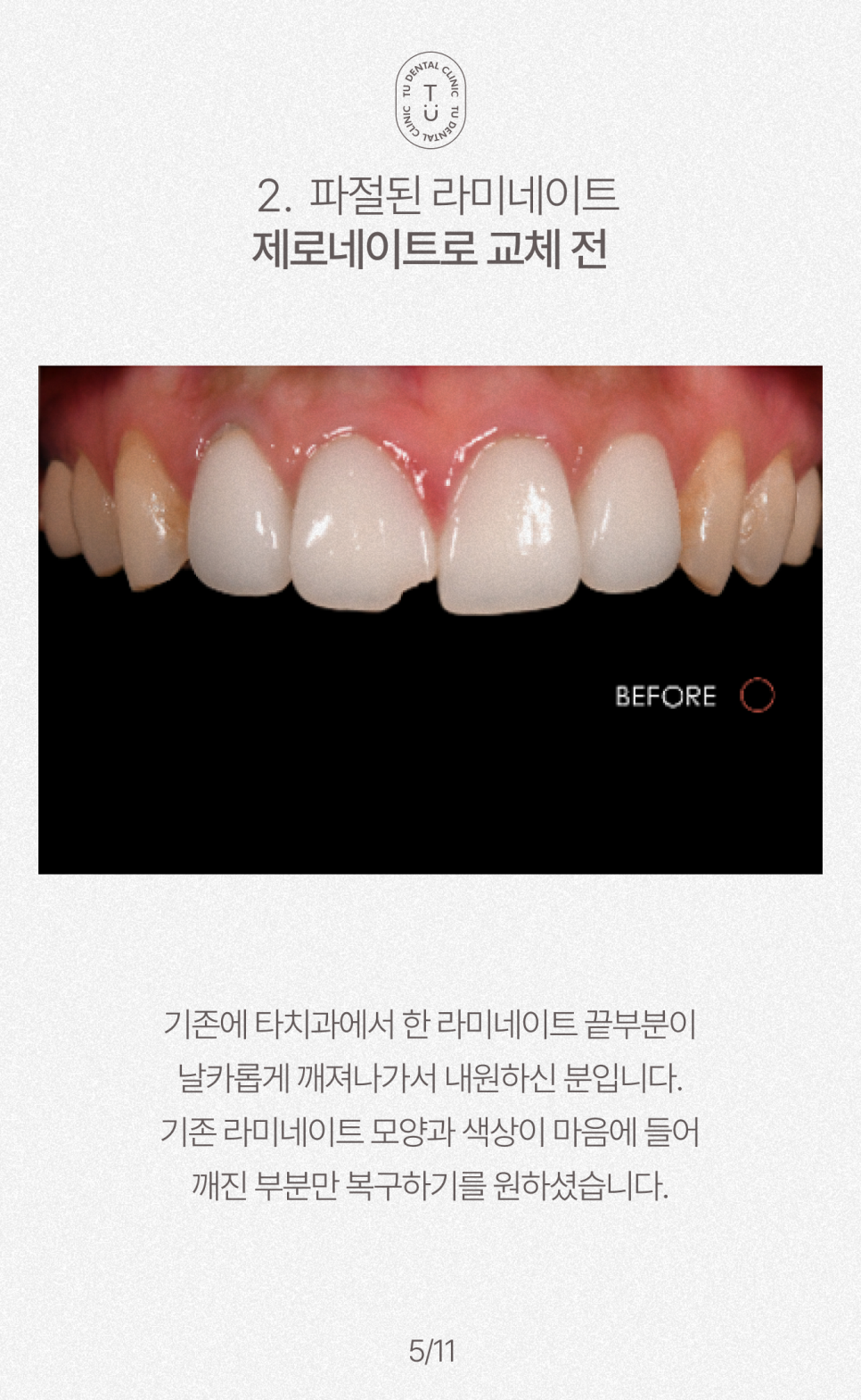 오래된 라미네이트 교체하셔야 됩니다, 티유치과[TU치과] 관련 이미지 6