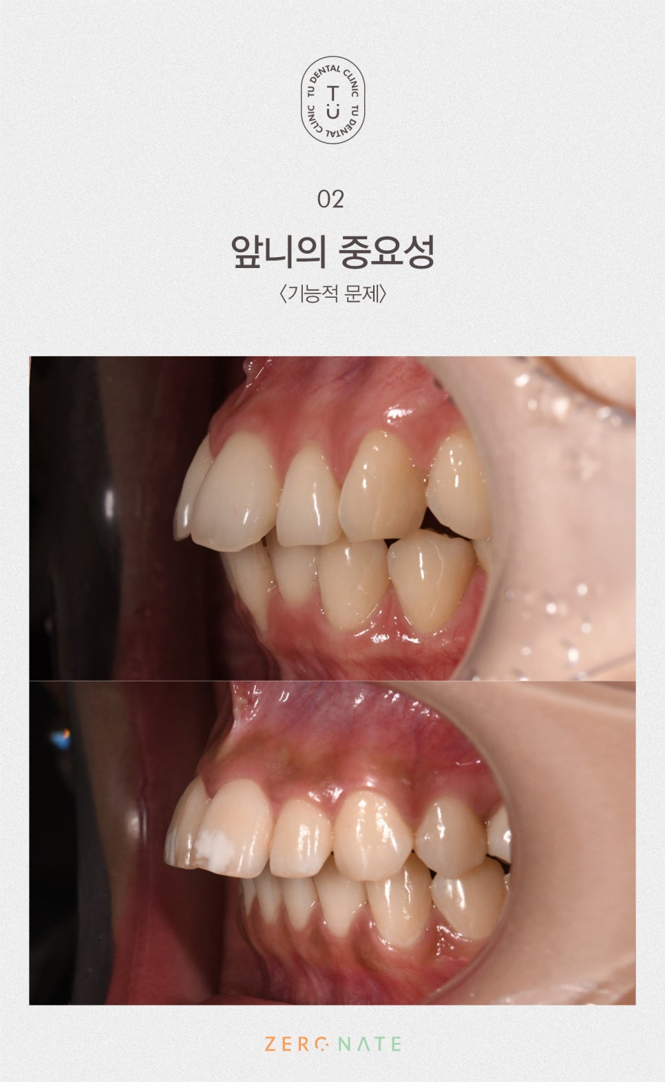 티유치과 돌출,불규칙한 치아 제로네이트[TU치과] 관련 이미지 3