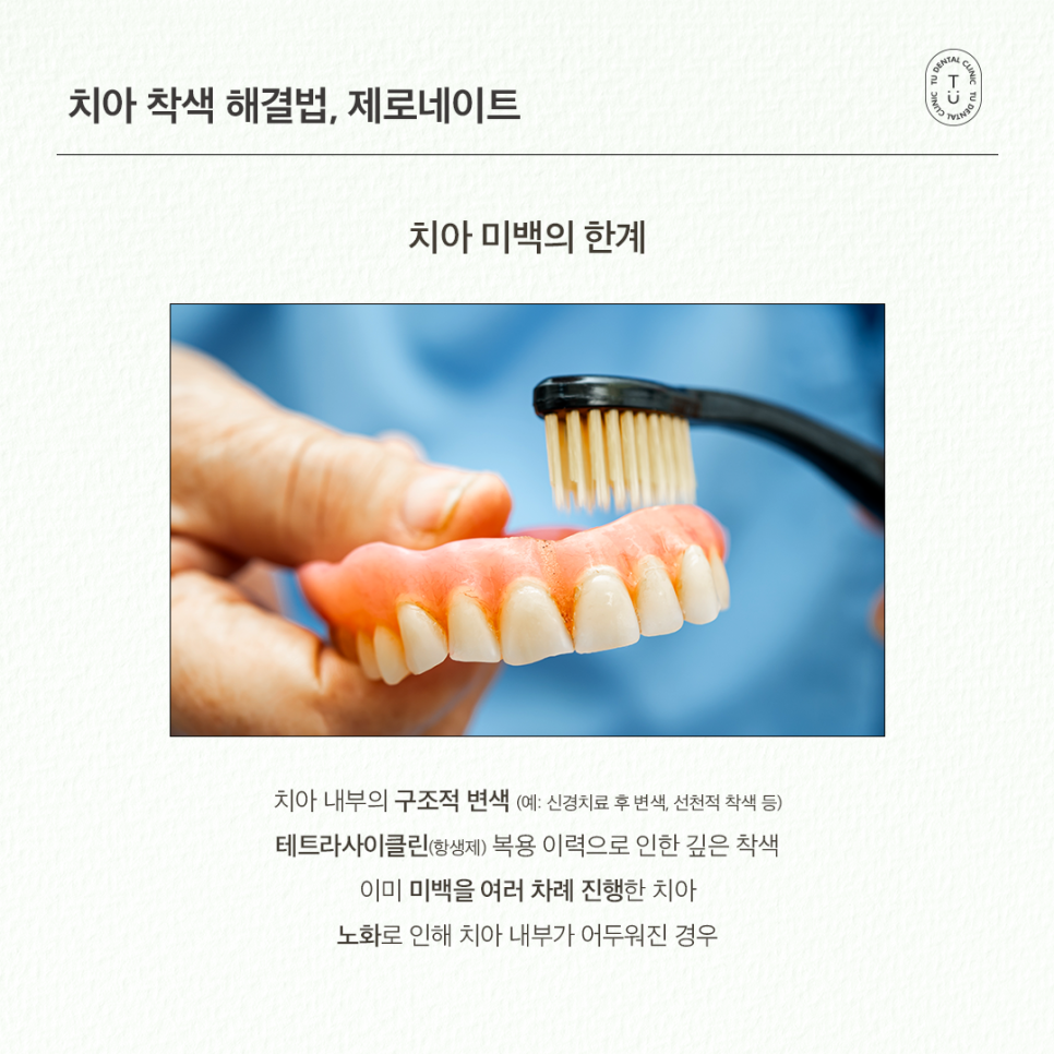 치아착색 제거, 손상없이 자연스럽게 티유치과 제로네이트 관련 이미지 2