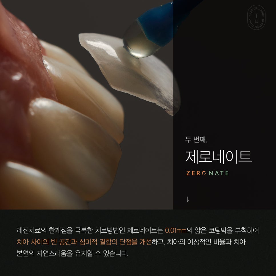 티유치과 4월 매거진, 블랙트라이앵글 치아의 치료법 [TU치과] 관련 이미지 5